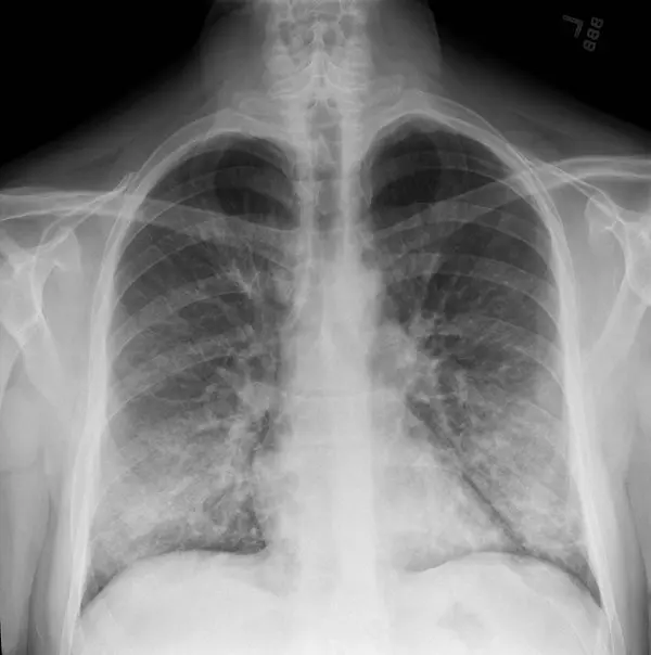 An X-ray of a patient with a vaping habit, showing lung damage — densities or whitish cloud-like areas typically associated with some pneumonias, fluid in the lungs or inflammation.